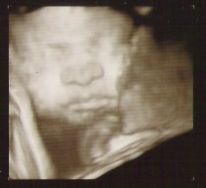 3d ultrasound scan. 3D Ultrasound of My Niece